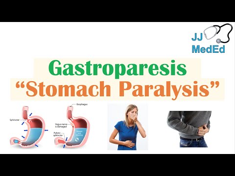 Video: Gastroparesi: Cause, Sintomi E Diagnosi