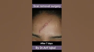 Face Scar surgery @DesignerDoctor #scarsurgery #scartreatment #skin #skintreatment