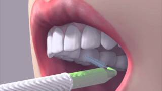 How to use an interdental brush