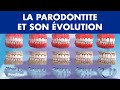 Gingivite, parodontite et son évolution ©