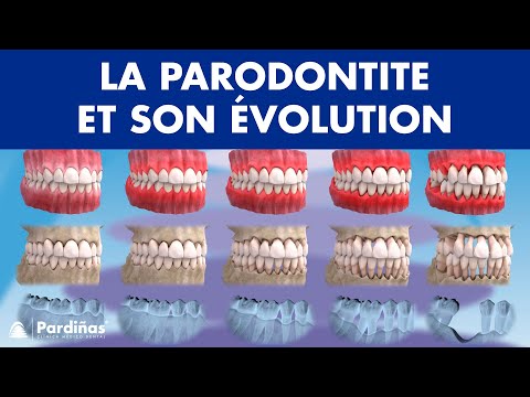 Vidéo: Gingivite Et Maladie Parodontale Chez Les Furets