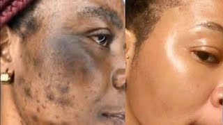 Get Clear skin and remove MELASMA #skincare #skincareroutine #acne 