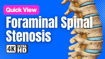 Foraminal Stenosis & Foraminotomy | 3D Spine Animation (No Narration)