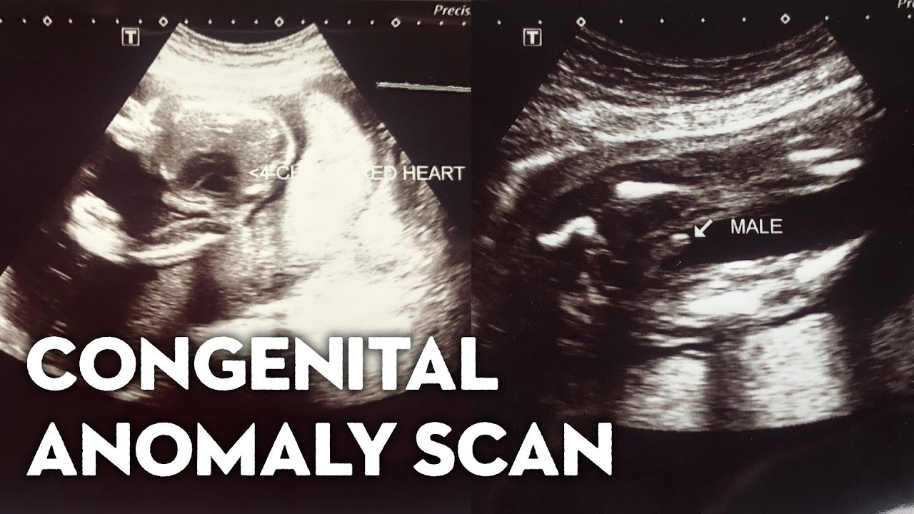 Congenital Anomalies congenital-anomalies
