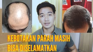 BOTAK LICIN MASIH BISA DIATASI ? #PEJUANGGANTENG