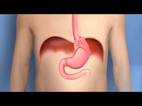 Video: Vad är esophagogastrectomy procedure?