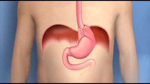 Anti-reflux Surgery, Fundoplication-Mayo Clinic