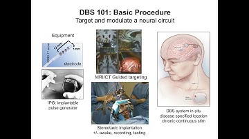 Deep Brain Stimulation for Treatment-Resistant Depression: A Progress Report