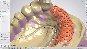 3Shape Dental System Removable Partial Framework Design and SLM Production with Tim Bertram