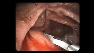 Colonoscopy Channel - Control of delayed bleeding after polypectomy