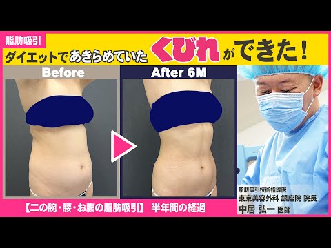 【脂肪吸引レポ】ダイエットでも手に入らなかった…憧れのくびれを手に入れたい！