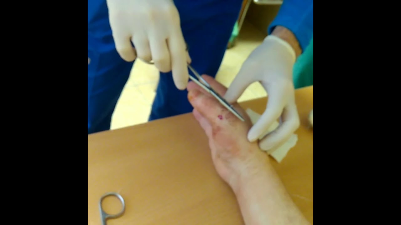 Перелом! Как мне снимали спицы! НЕ БОЛЬНО!