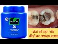 2 मिनट में दांत दर्द ख़त्म करने का घरेलू इलाज|Home Remedy for Toothache,Dant dard ka ilaj