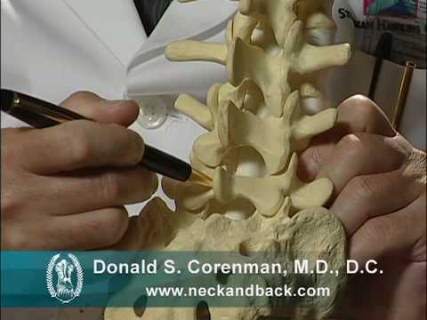 Isthmic Spondylolisthesis Video | Stress Fracture of the Back Vertebra | Spine Surgeon Colorado