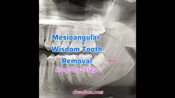 Essential Tools & Techniques for Effortless Wisdom Tooth Extraction #shorts