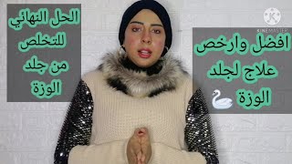 افضل وارخص علاج لجلد الوزة والشعر تحت الجلد