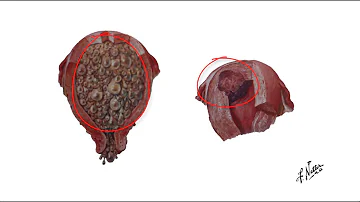 O que são Coriocarcinomas como eles se formam?