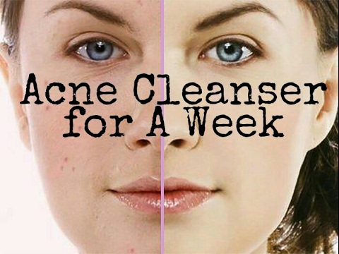 acne cleanser  Acne Prone / Sensitive Skin How To Cure Acne - FOR SENSITIVE SKIN!