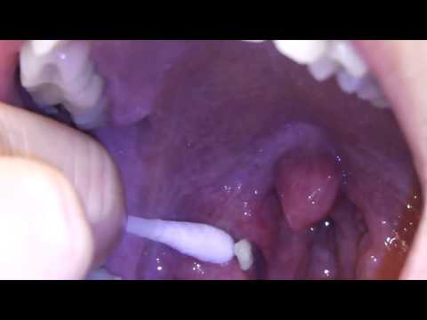 Tonsil Stones Removal With Tips ♦ Treatment At Home READ DESCRIPTION Below