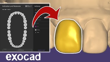 VENEER EXOCAD. Total BEGINNER Tutorial