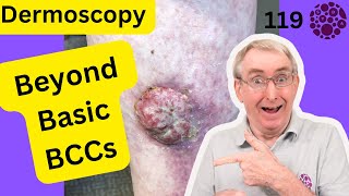 Uncover the secrets of Big Basal Cell Cancers, as I take you beyond the basics of BCC dermoscopy.