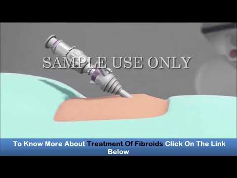 fibroids-surgery---uterine-artery-embolization-for-fibroids-removal