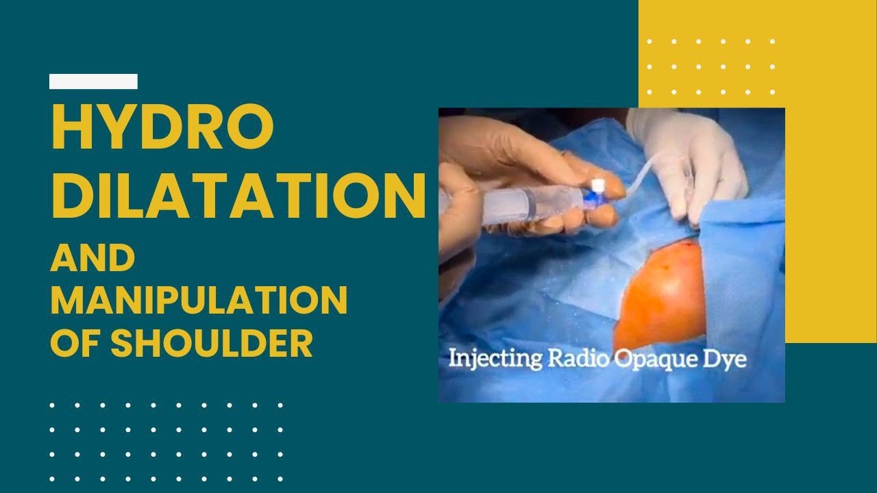 HYDRODILATATION AND MANIPULATION OF SHOULDER FOR ADHESIVE CAPSULITIS ( FROZEN SHOULDER). YouTube