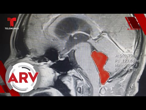 Vídeo: El Estadounidense Ha Vivido Durante Diez Años Con Un Gusano En Su Cerebro - Vista Alternativa