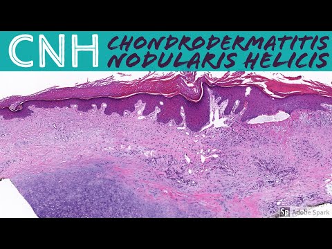 Chondrodermatitis nodularis helicis (CNH)