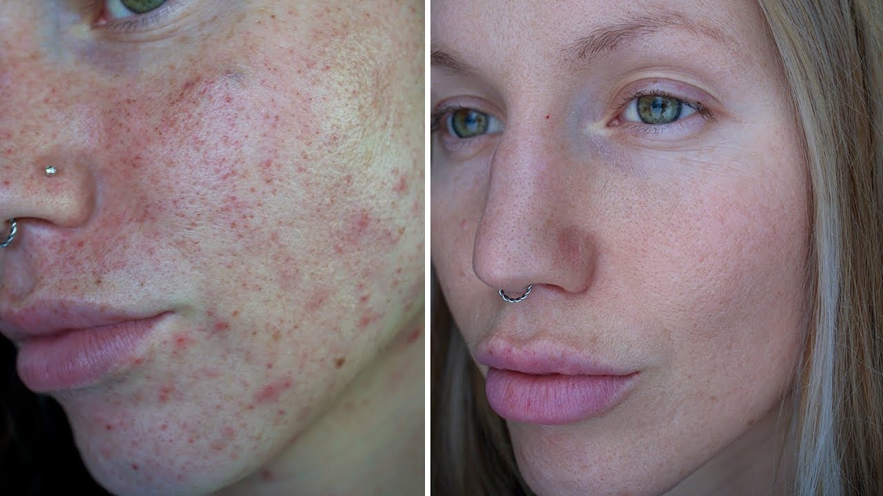 How I cured my ACNE!! | My skin story | @jayyroot - YouTube