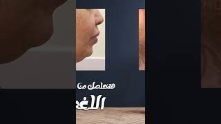 شد اللغد ( شد اللغلوغ ) الدكتور عمرو عادل مصطفى استشاري جراحات التجميل