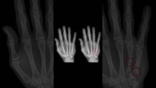 Metacarpal Bones Explained 🖐️#anatomy #meded #ortho #handanatomy #surgery #radiology #physiotherapy