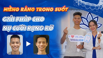 Niềng răng trong suốt Vinalign - Giải pháp cho nụ cười rạng rỡ | Nam Bùi Vinalign