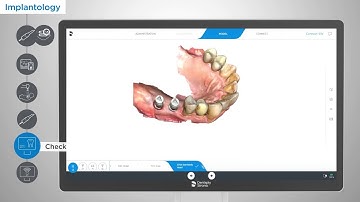 Streamlining Excellence: Implantology Workflow with Primescan
