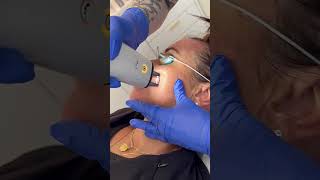 Nordlys Frax Best Skin Yet Bare Medical Spa