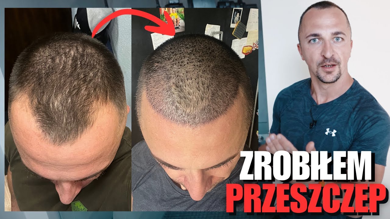 Zrobiłem PRZESZCZEP włosów w Turcji - YouTube