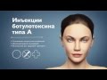 Инъекции ботулотоксина