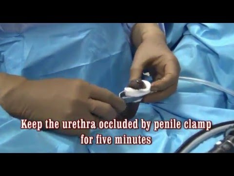 cystoscopy male surgery urethra urology anaesthesia videos