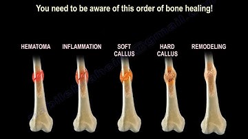 How Does Broken Bone Heal?