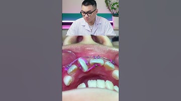 Răng mọc ngang ngược khắc phục thế nào #nhakhoa #shorts #fyp #vidental