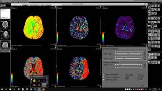 Применение программы КТ Перфузия головного мозга в клинической практике