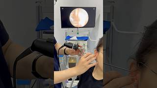 Ultimate Giant Earwax Extraction 😍 | Extreme ENT Cleaning Satisfaction #EarCleaning #Viral #Health
