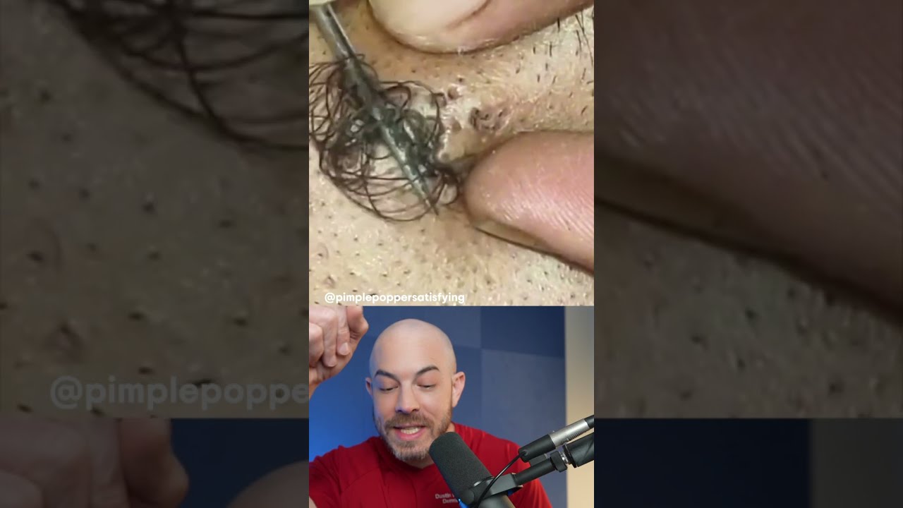 Monsterous Ingrown Hair Ingrownhair Doctorreacts