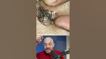 Monsterous Ingrown Hair Ingrownhair Doctorreacts 