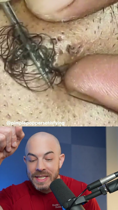 Monsterous ingrown hair😱 #ingrownhair #doctorreacts