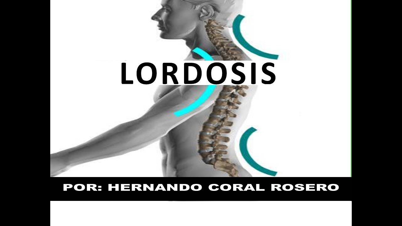 LORDOSIS 