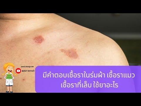 มีคำตอบเชื้อราในร่มผ้า เชื้อราแมว เชื้อราที่เล็บ ใช้ยาอะไร