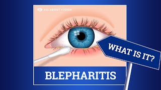 Szemhéjszéli gyulladás (blepharitis)