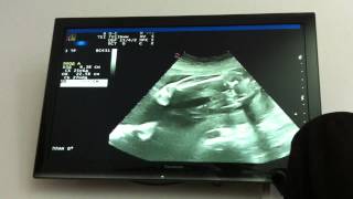 видео 26 неделя беременности   ждем малыша ру
