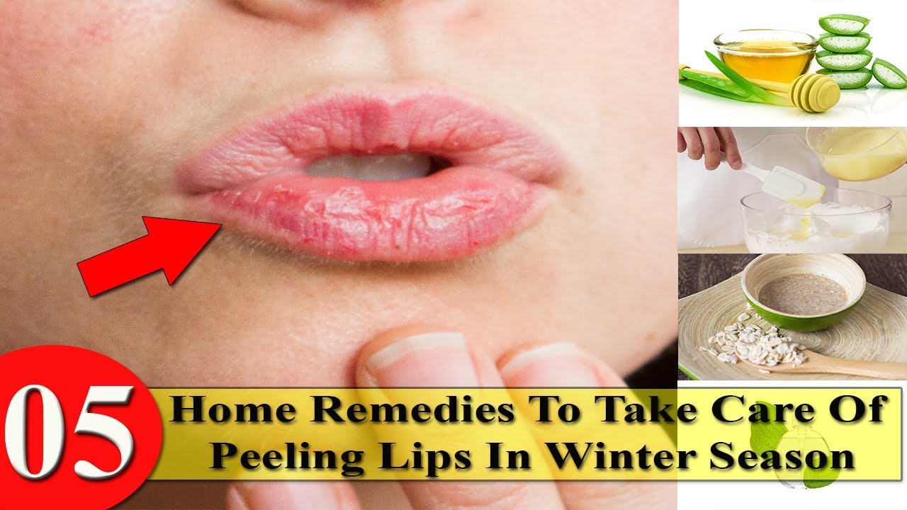 5 land house Remedies To acknowledge Care Of Peeling Lips In Winter